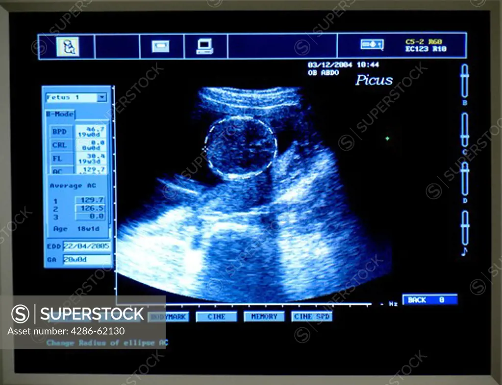 Ultrasound investigation, ultrasonic figure
