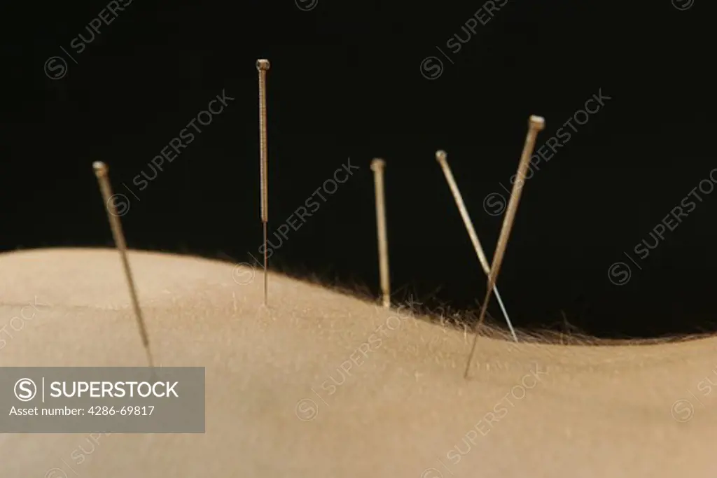 Young woman with an acupuncture treatment