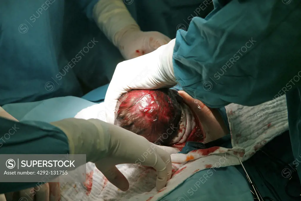 Frau bei einer Entbindung durch Kaiserschnitt im OP-Kreissaal, Caesarian operation
