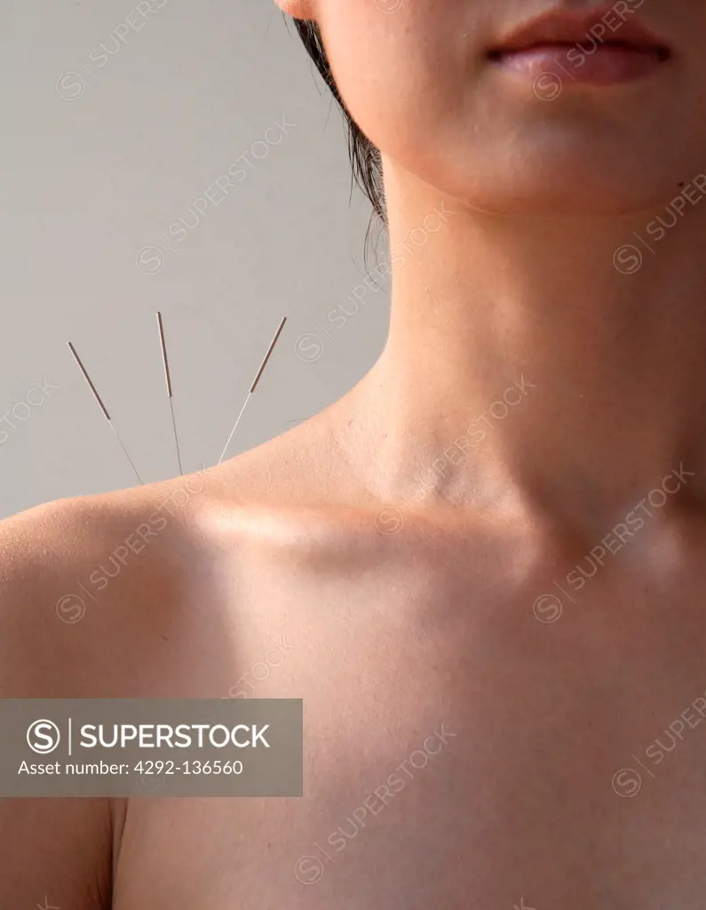 Woman having acupuncture treatment on shoulder