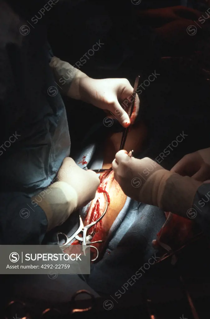 Surgeon hands at work