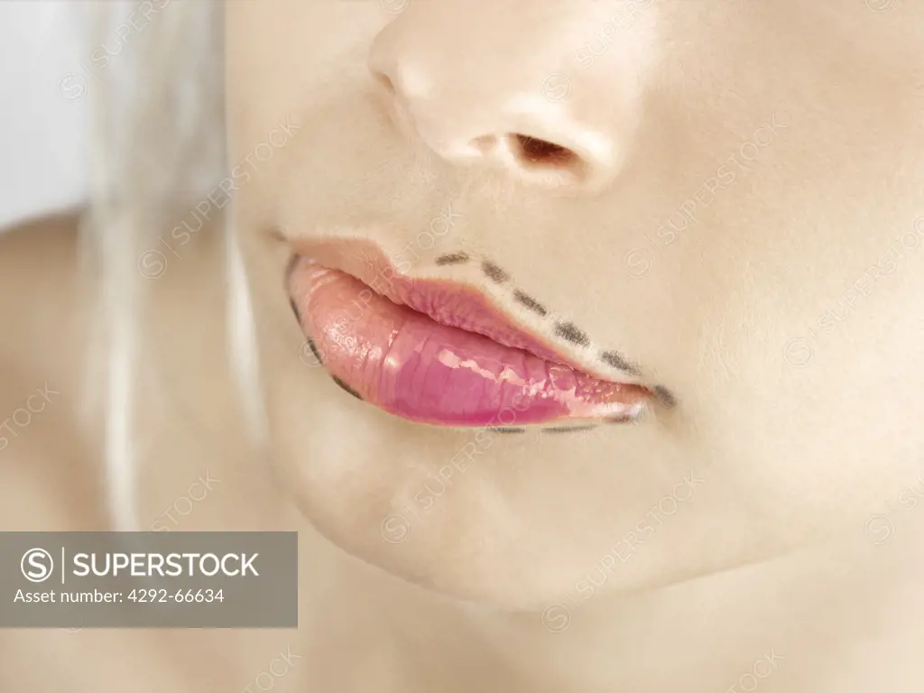 Woman with markings around lips