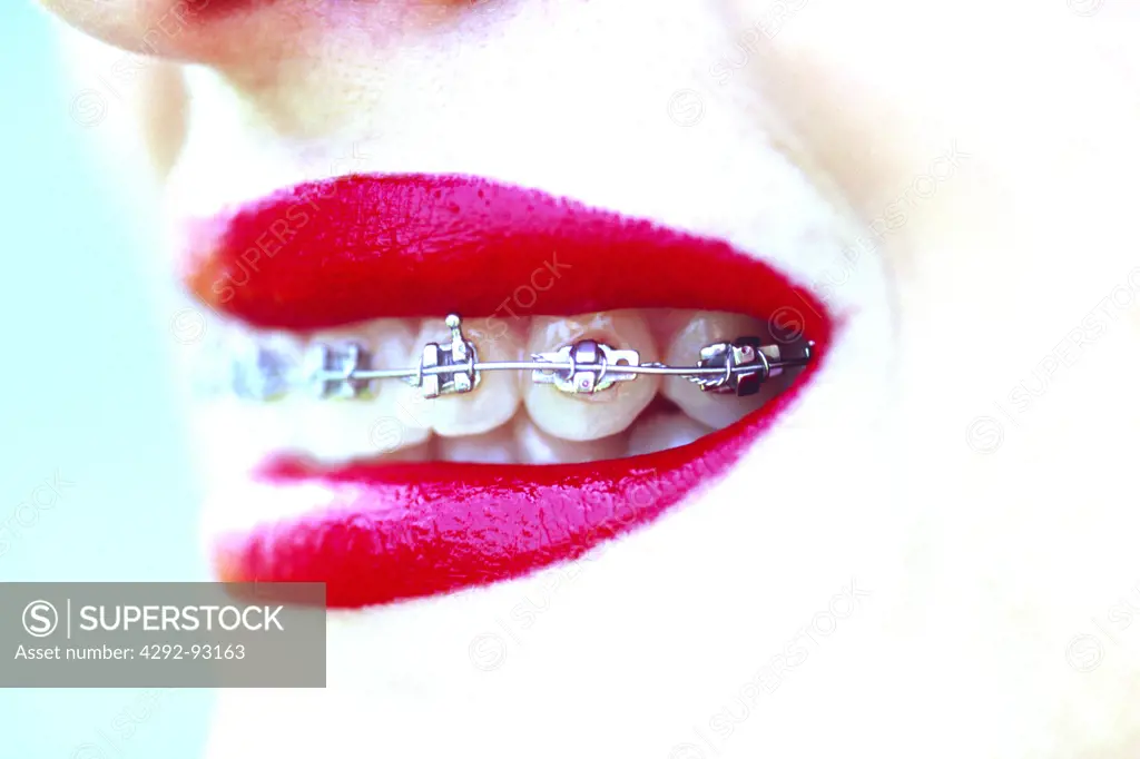 Close up of woman's mouth with braces