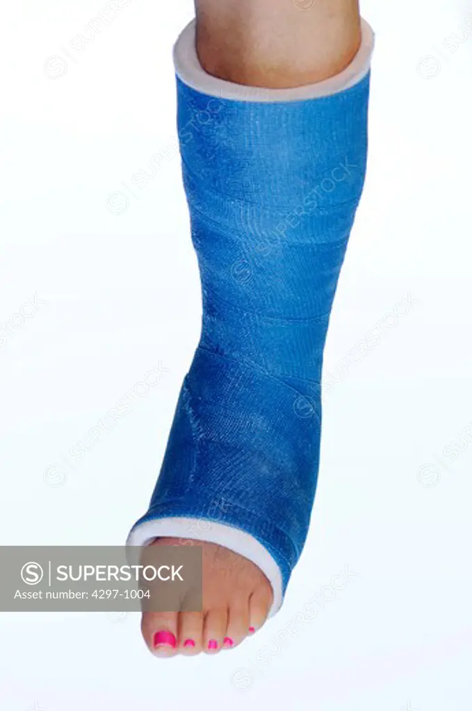 Woman with a broken ankle in a blue fiberglass cast