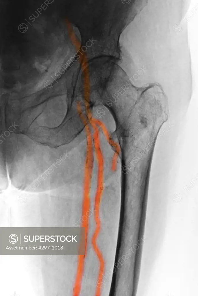 X-ray showing calcification of the external iliac and femoral arteries and its branches