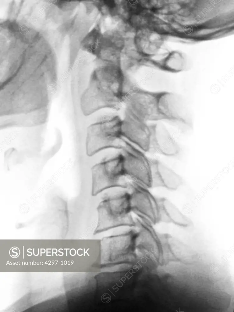 Normal cervical (neck) x-ray of a 51 year old woman who was seen in the Emergency Room after a car accident complaining of neck pain