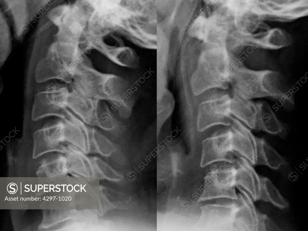 Composite of two views of normal cervical (neck) x-ray of a 51 year old woman who was seen in the Emergency Room after a car accident complaining of neck pain