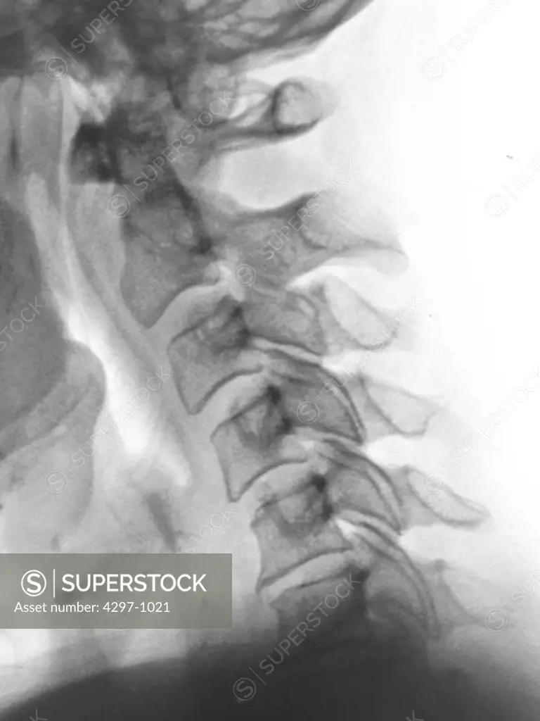 Normal cervical (neck) x-ray of a 51 year old woman who was seen in the Emergency Room after a car accident complaining of neck pain