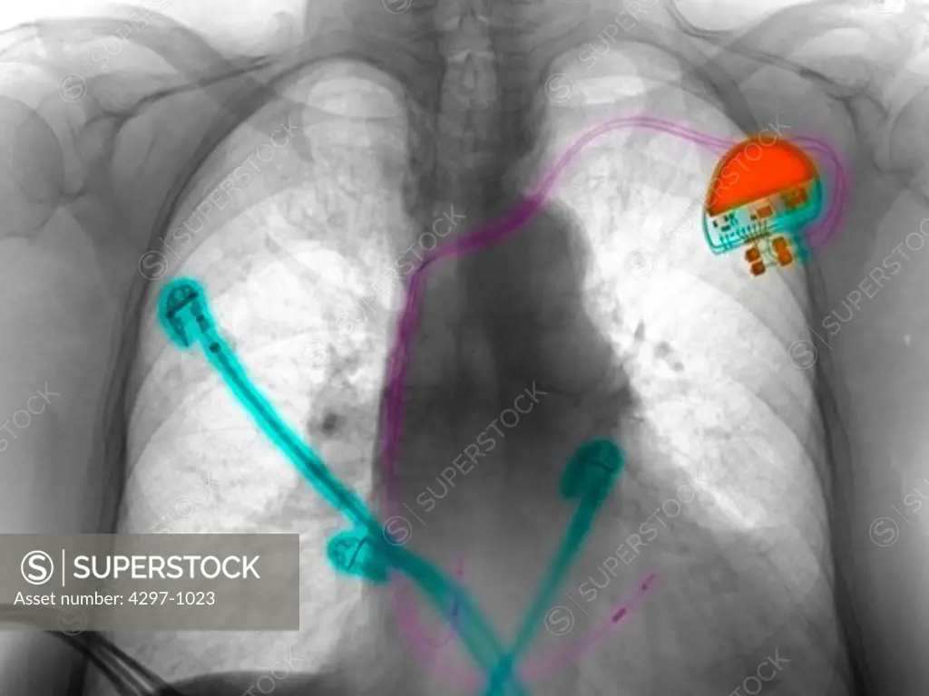 Chest x-ray (CXR) of a 91 year old woman with a pacemaker and cardiac monitoring leads, being treated in the intensive care unit
