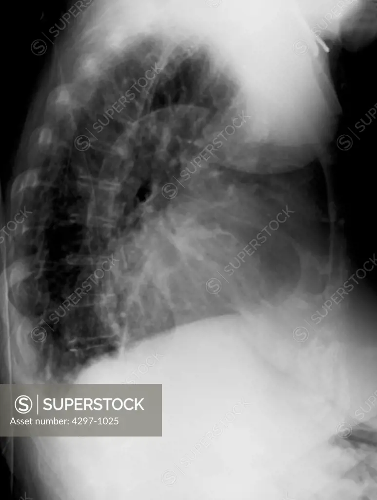 Chest x-ray of a 79 year old woman showing marked cardiomegaly. Diffuse calcifications are observed in the aorta. Pulmonary vascular congestion present suggestive of congestive heart failure (CHF) and pulmonary edema. Increased interstitial densities are seen in the middle and lower lung fields