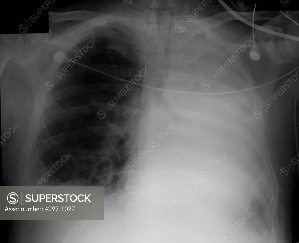 Chest x-ray of a 77 year old man with congestive heart failure. The x-rays shows pulmonary edema resulting in opacification of his entire left chest