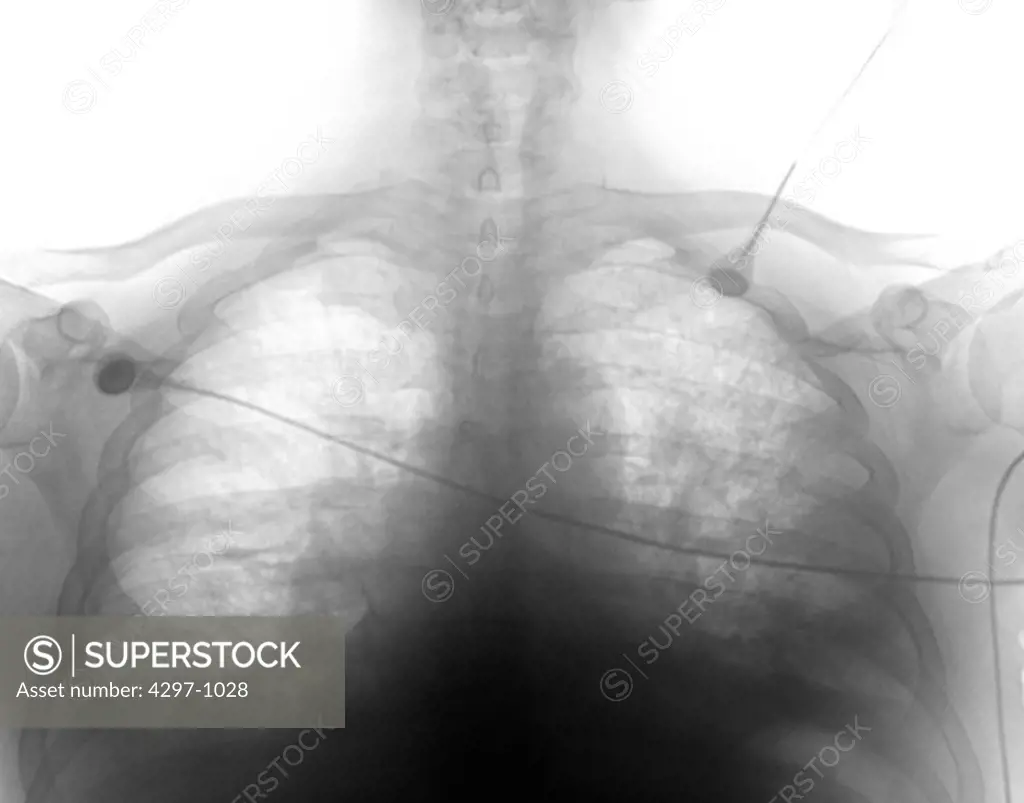 Chest x-ray of a 77 year old man with congestive heart failure. The x-rays shows early pulmonary edema