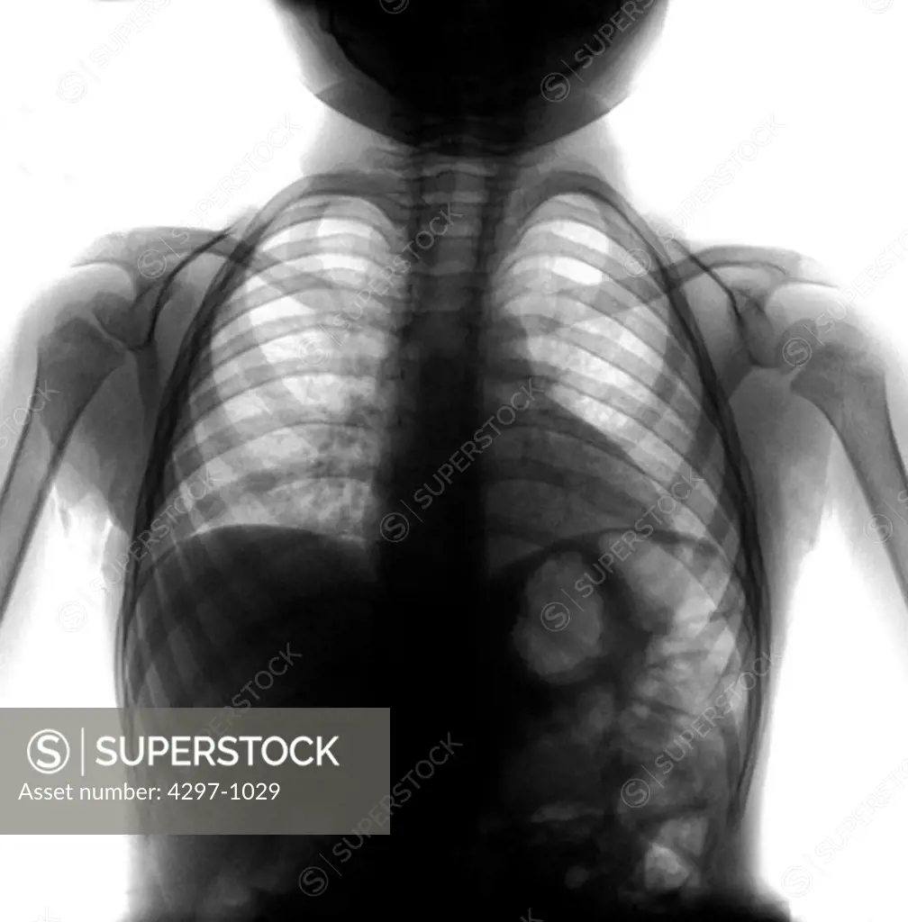 Chest x-ray of a 2.5 year old boy with influenza A who developed a right middle lobe pneumonia