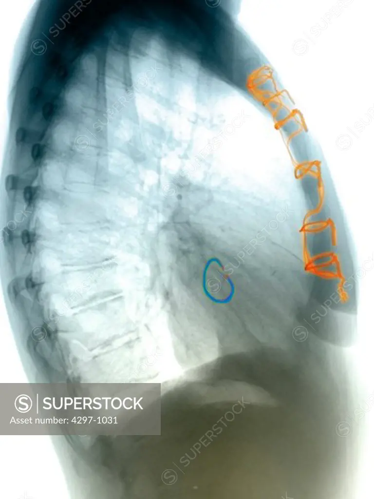 Chest x-ray of a 51 year old woman who underwent open heart surgery for the replacement of a heart valve