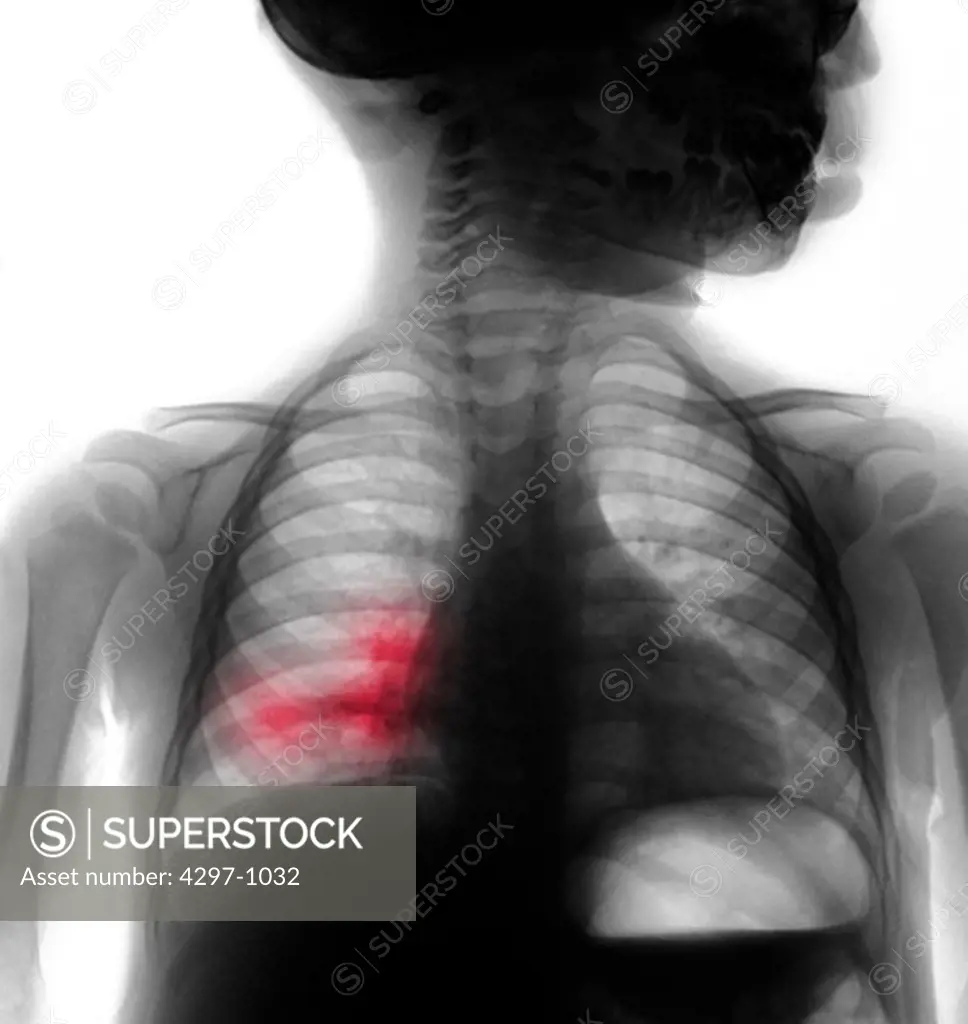 Chest x-ray of a 16 month old boy with a four day history of fevers to 104 degrees. There is a right middle lobe pneumonia