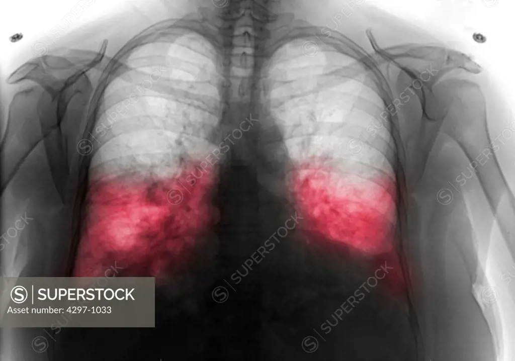 Chest x-ray of a 62 year old woman showing bilateral lower lobe pneumonia. There is obliteration of the costophrenic angles and hemidiaphragmatic and cardiac silhouette. There is bilateral lower lobe airspace opacity. The upper lobes are clear