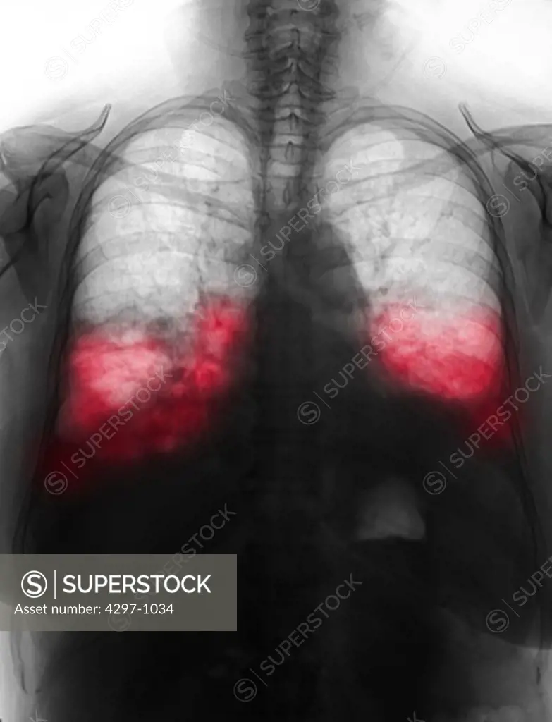 Chest x-ray of a 62 year old woman showing bilateral lower lobe pneumonia. There is obliteration of the costophrenic angles and hemidiaphragmatic and cardiac silhouette. There is bilateral lower lobe airspace opacity. 