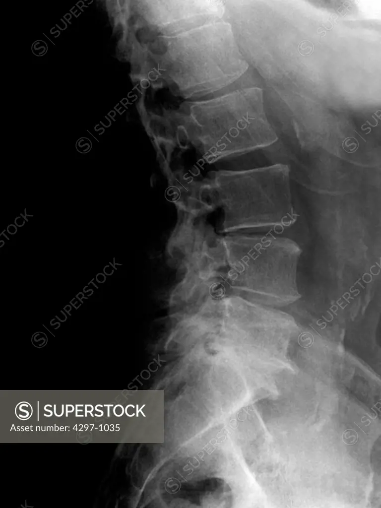 Lumbar spine lateral view of a 64 year old man with degenerative changes at the L5-S1 vertebrae disc space
