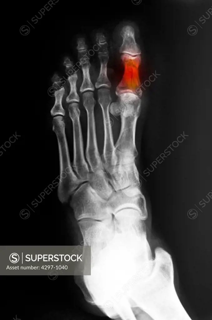 Foot x-ray of a 52 year old man with a fracture of his great toe, highlighted in color