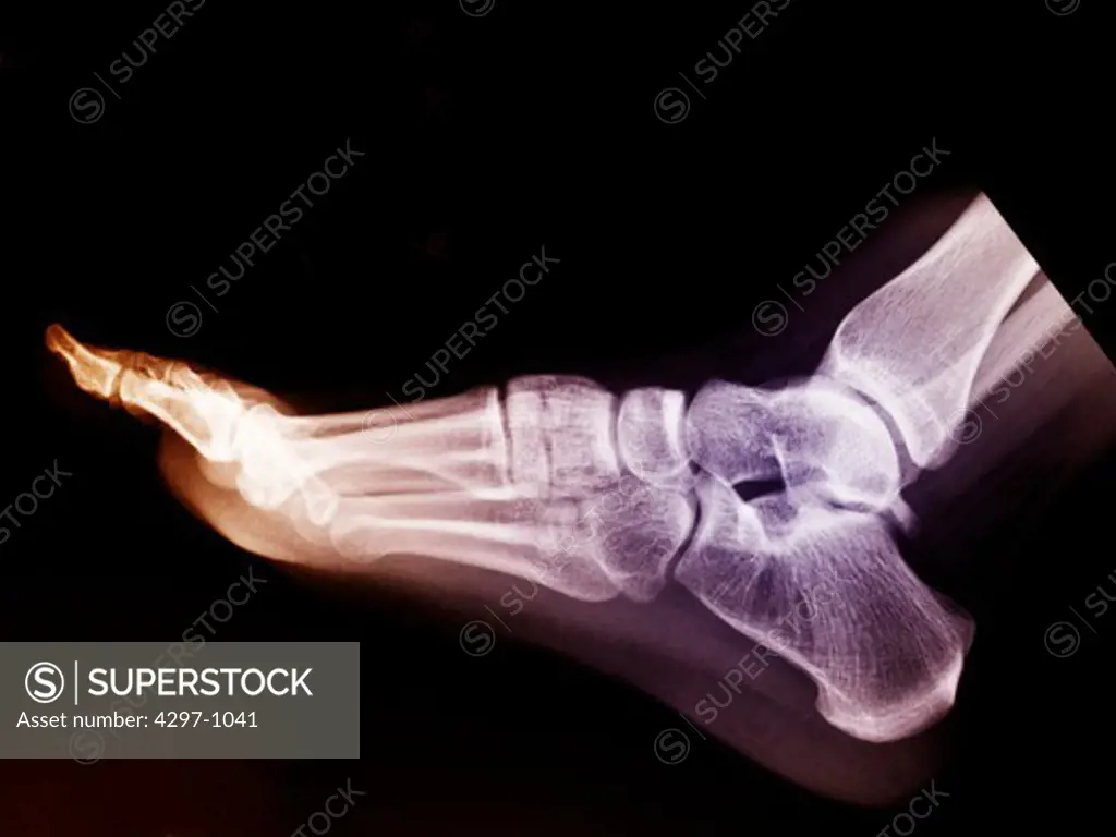Normal foot x-ray of a 17 year old girl