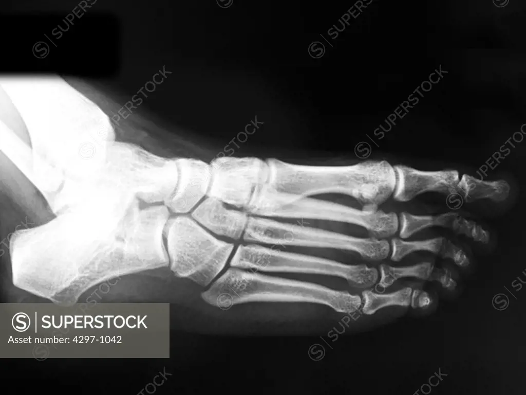 Normal foot x-ray of a 17 year old girl