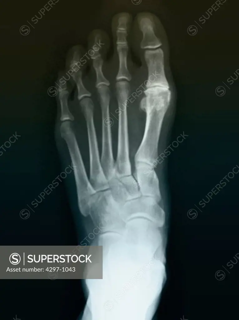 Normal foot x-ray of a 59 year old woman