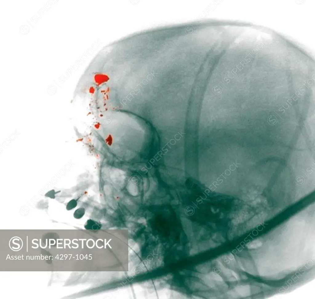 X-ray showing a gunshot wound to the head