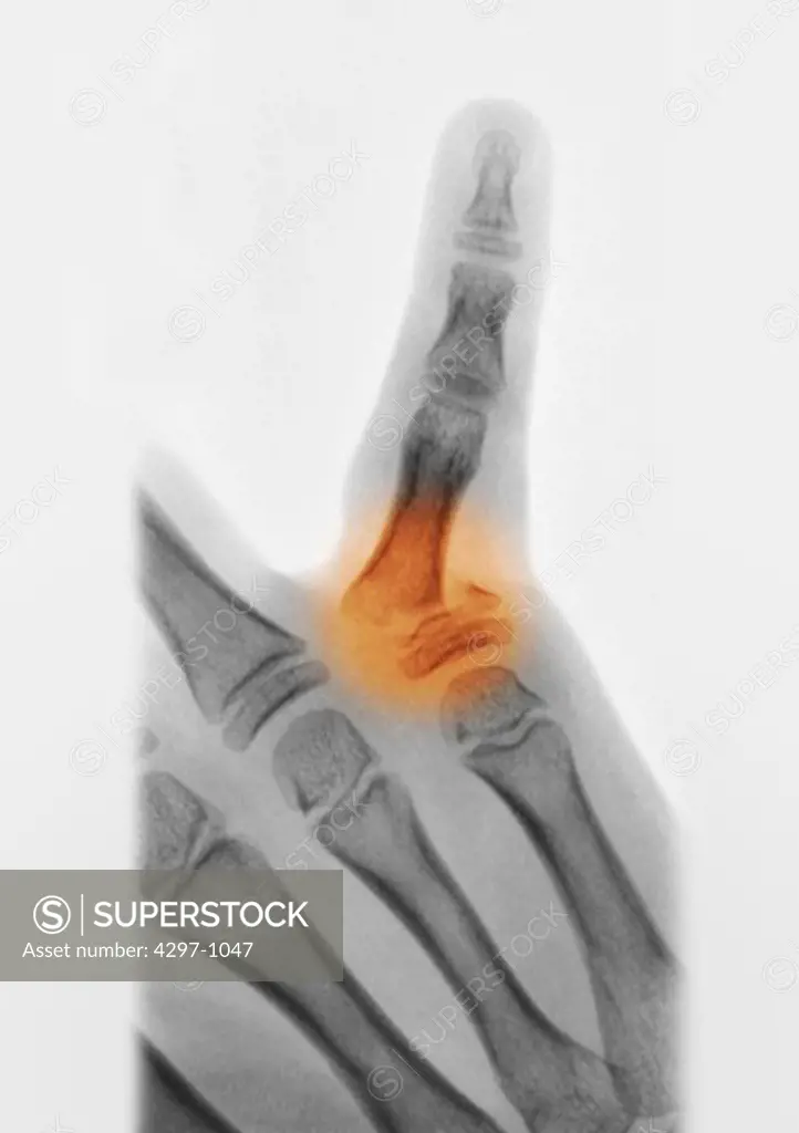 X-ray of the hand of an 8 year old girl who fractured the proximal phalanx of her 5th finger at the base