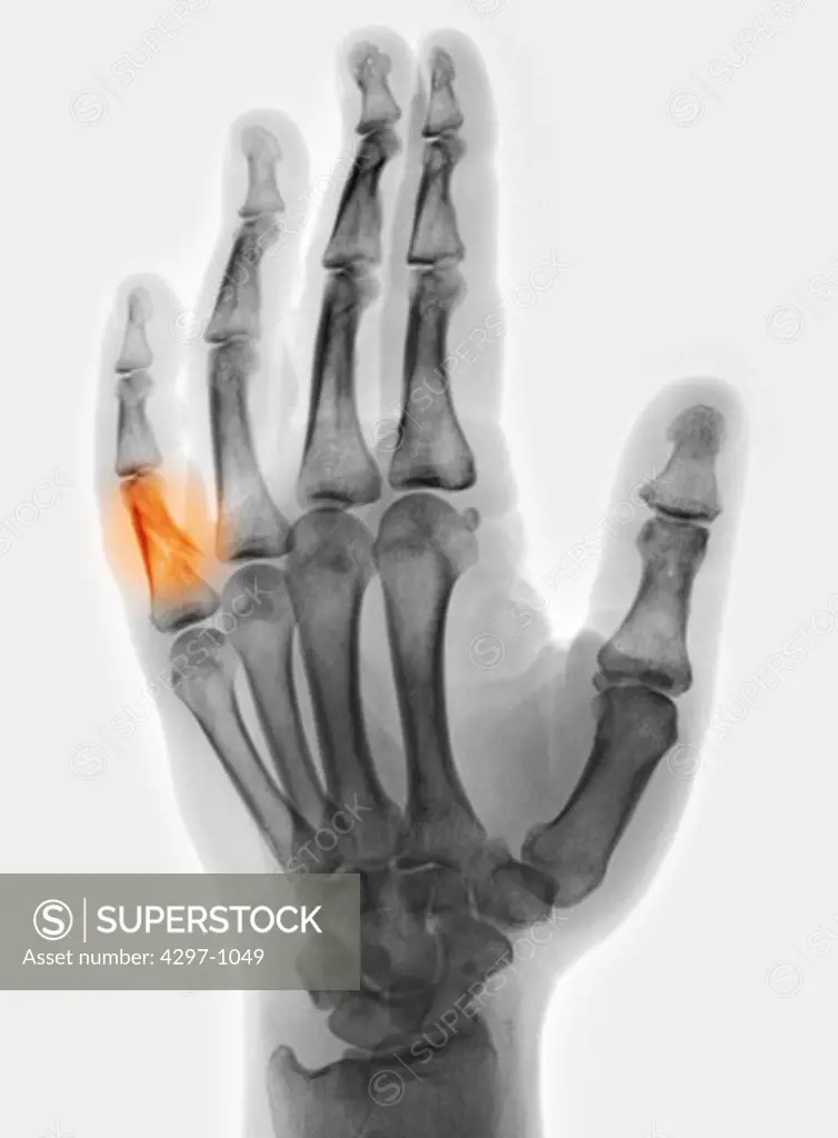 Hand x-ray of a 53 year old man who fractured the proximal phalanx of his 5th finger