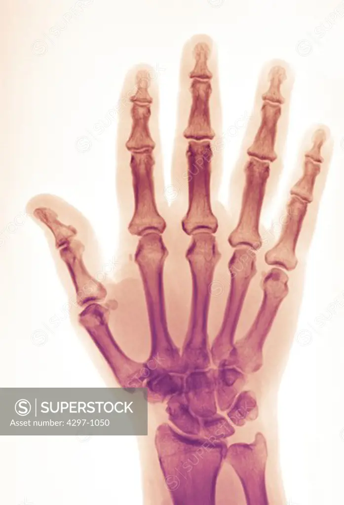 Normal hand x-ray of a 56 year old man, who dislocated his the middle finger at the interphalangeal joint, and had the dislocation reduced in the emergency room