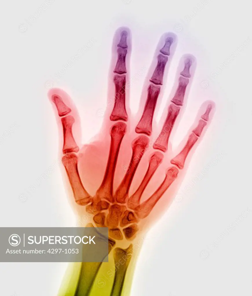 Normal hand x-ray of a 15 year old boy