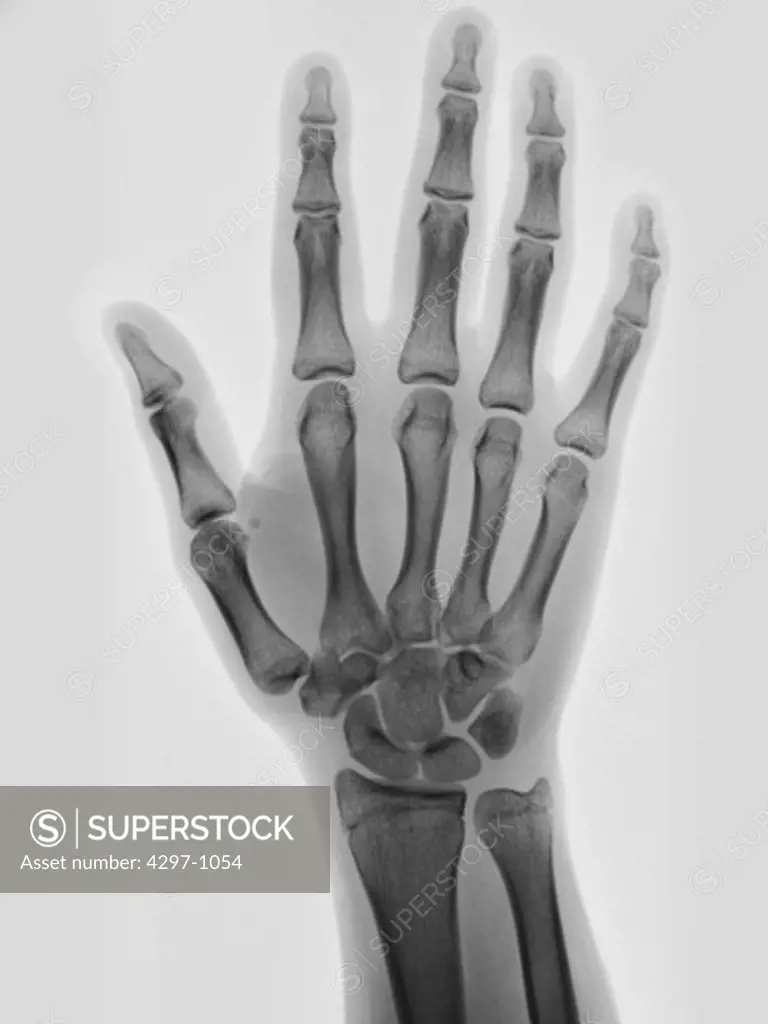 Normal hand x-ray of a 17 year old girl