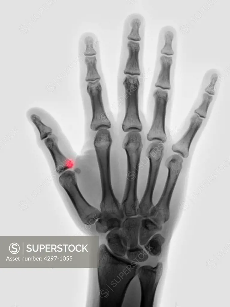 Hand x-ray of a 17 year old woman showing a small fracture at the base of the of the thumb