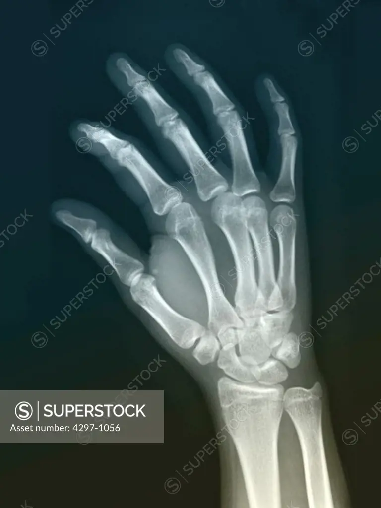 Normal hand x-ray of an 18 year old girl