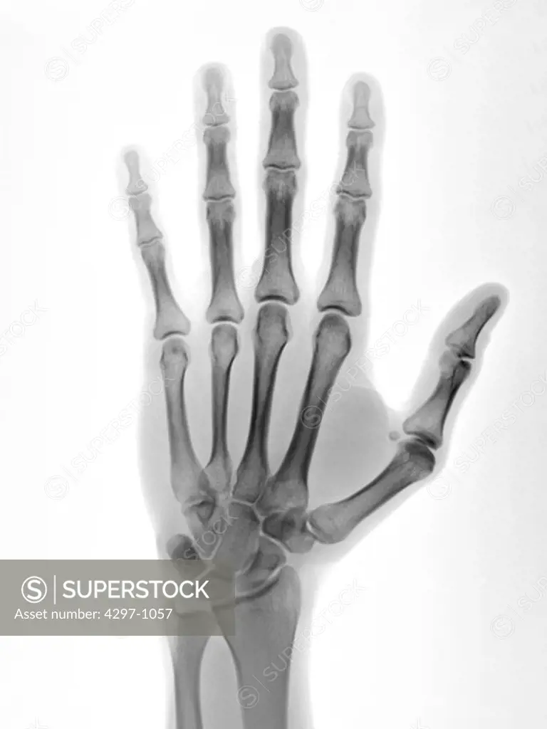 Normal hand x-ray of a 22 year old man