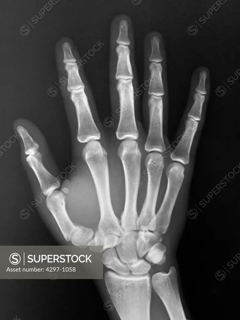 Normal hand x-ray of a 19 year old boy