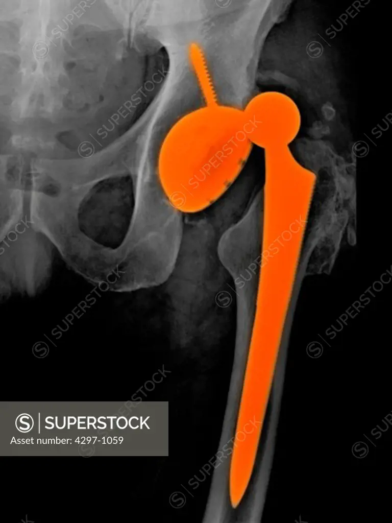 X-ray of a 74 year old man with a dislocation of his hip replacement