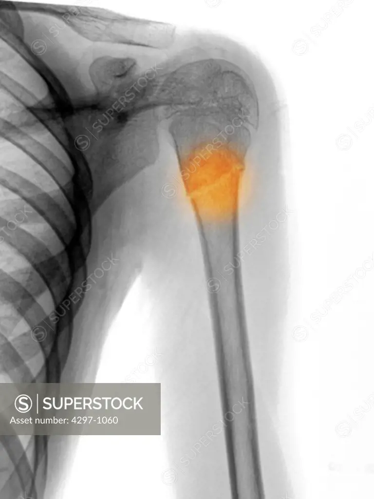 X-ray showing a proximal humerus fracture in a 15 year old boy