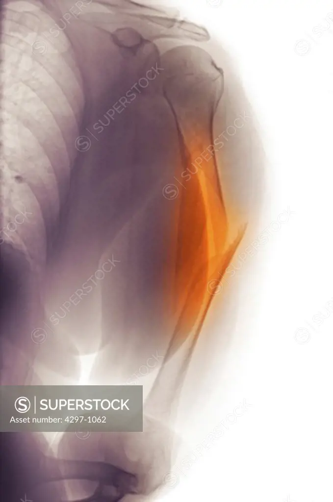 X-ray of a 74 year old woman showing a comminuted fracture of the humerus