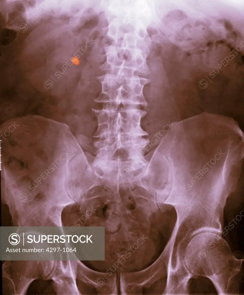 Abdomen x-ray of a 73 year old man with a 1 cm stone in his right kidney