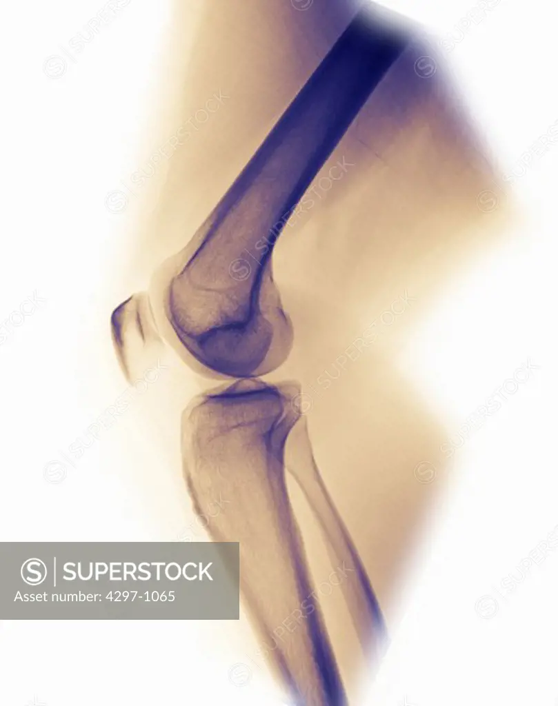 Normal knee x-ray of a 33 year old woman