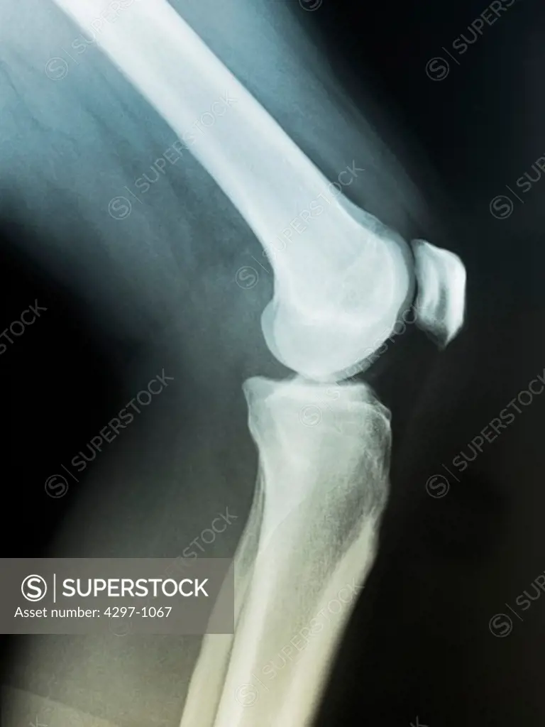 Normal knee x-ray of a 39 year old man