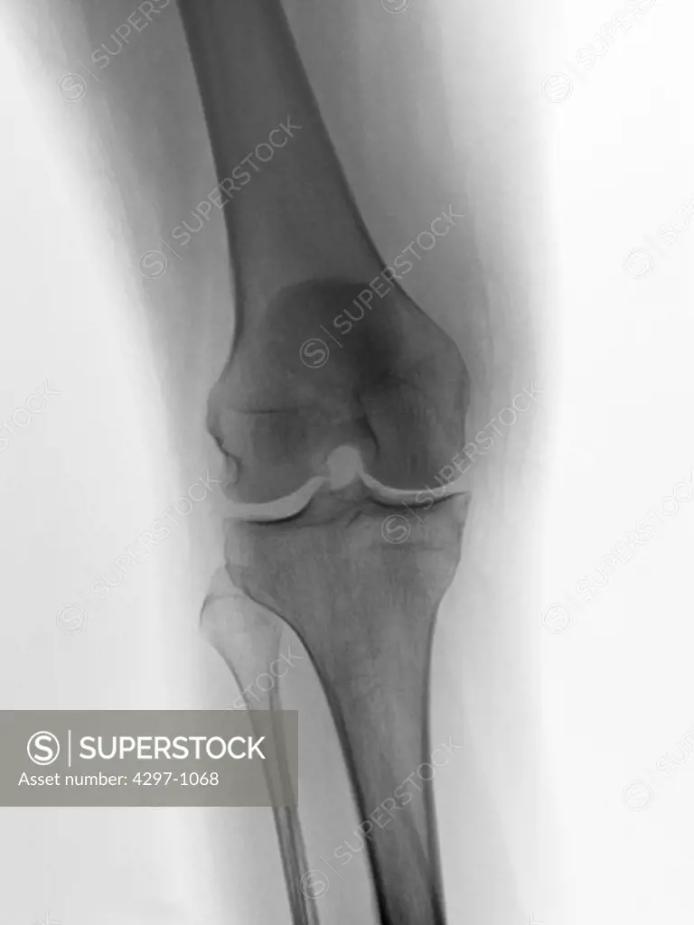 Normal knee x-ray of a 49 year old woman
