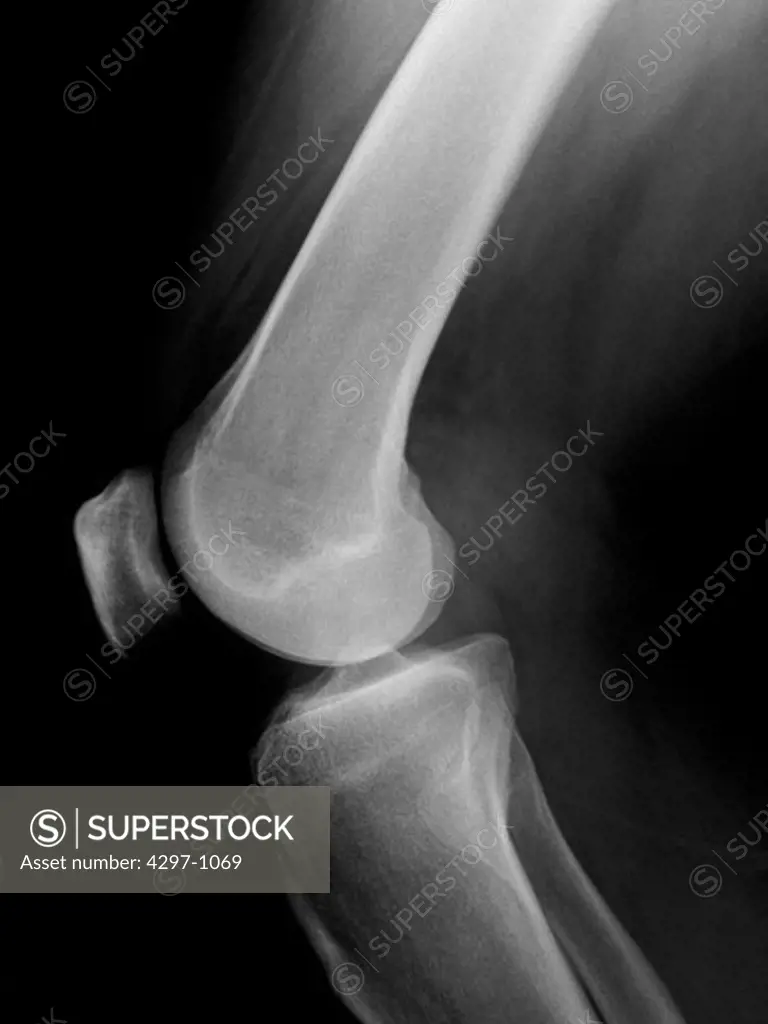 Normal x-ray of the knee of a 51 year old man