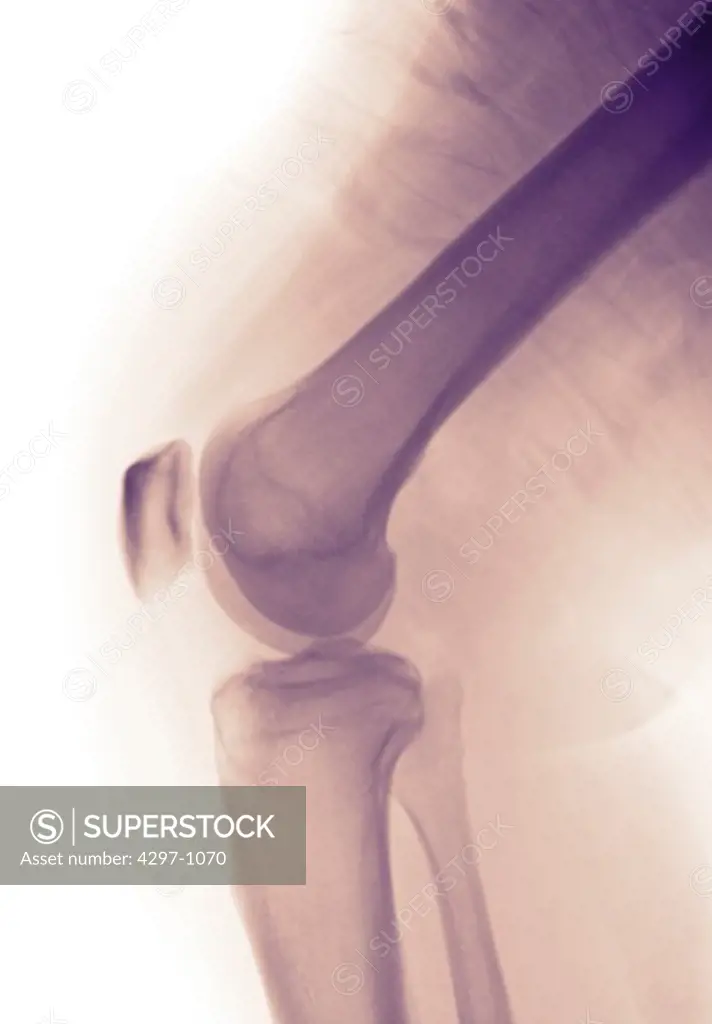 Normal knee x-ray of a 58 year old man