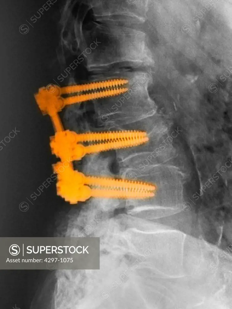 Lumbar spine of an 80 year old man with spinal fusion hardware