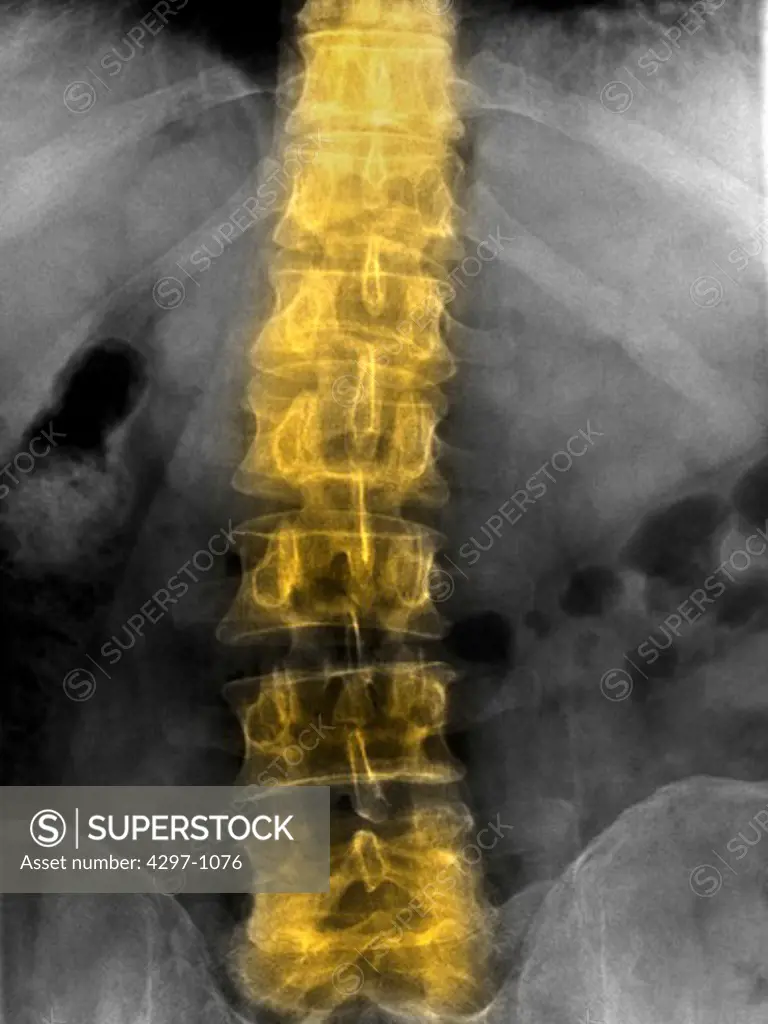 Lumbar spine x-ray of a 41 year old man showing minor degenerative changes