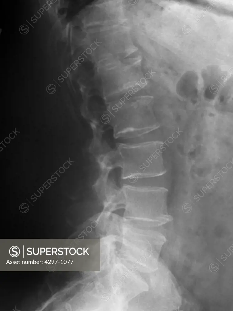 Lumbar spine x-ray of a 41 year old man showing minor degenerative changes