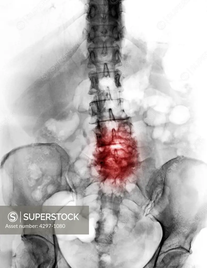 Lumbar spine x-ray of a 64 year old male with degenerative arthritic changes in the lower back, highlighted in color
