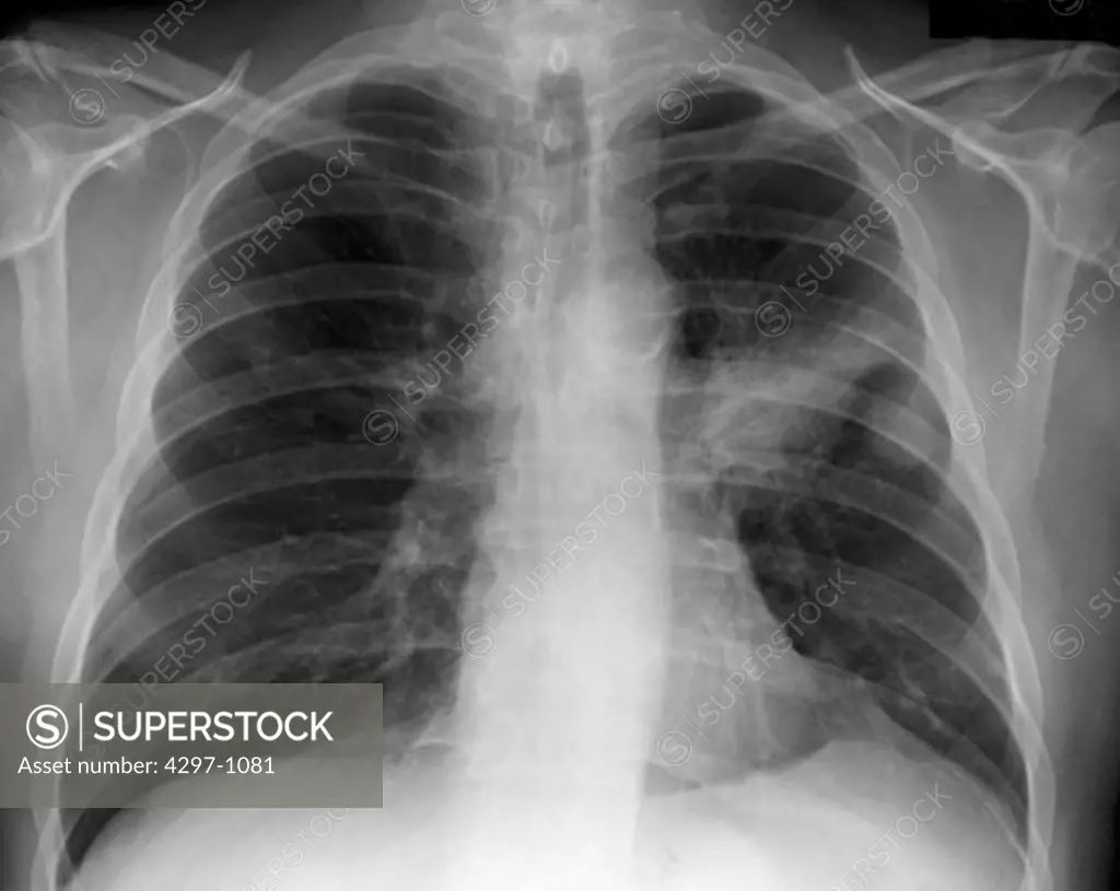 Chest x-ray of a 71 year old smoker showing lung cancer in the left lung